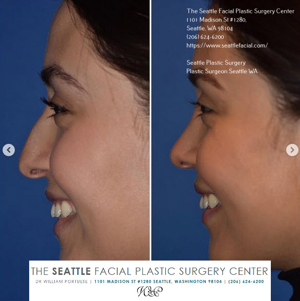 rhinoplasty for tip of nose